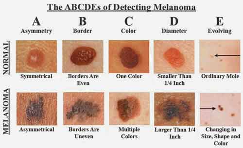 este important sa depistezi cancerul de piele cat mai din timp