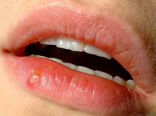 herpesul poate fi tratat peste noapte cu usturoi