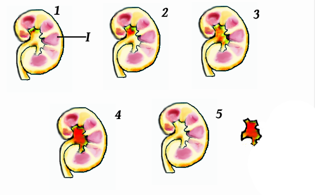 pietrele la rinichi sunt depozite minerale care ingreuneaza urinatia si predispun rinichii la imbolnavire