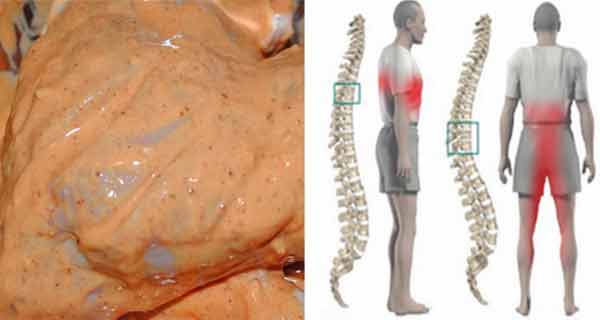 unguent eficient pentru durerile de spate osteoartrita articulației I metatarsofalangiene
