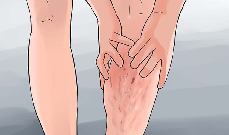 Cum se tratează varicele de pe picioare acasă