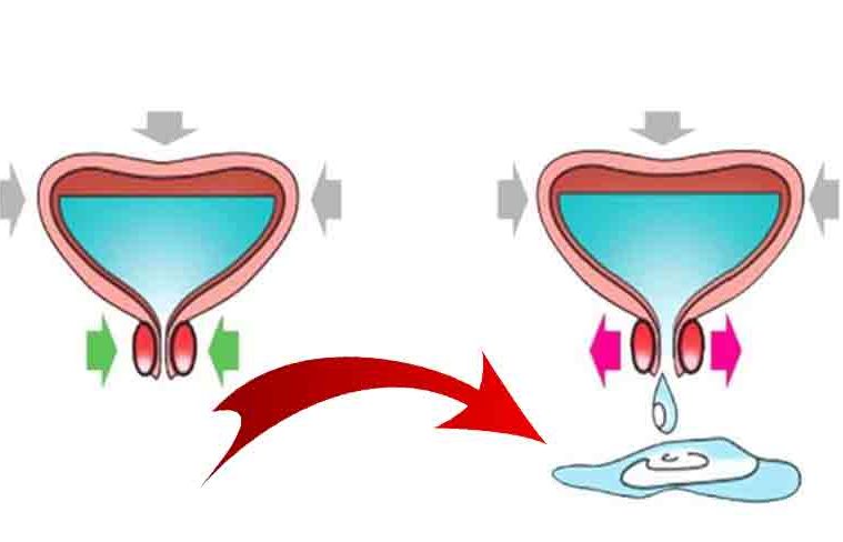 pierdere în greutate incontinență urinară